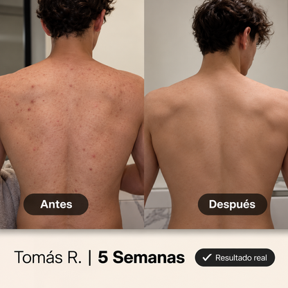 NUVA® Gel Limpiador para Acné Corporal