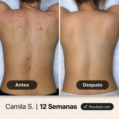 NUVA® Gel Limpiador para Acné Corporal